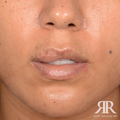 Lip Reduction / Lip Correction Before & After Gallery - Patient 103583 - Image 1