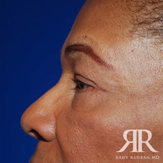Browlift Before & After Gallery - Patient 346293 - Image 6