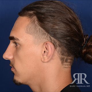 Ear Pinning Surgery Before & After Gallery - Patient 255708 - Image 4