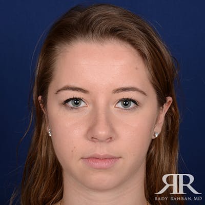 Chin Augmentation Before & After Gallery - Patient 374487 - Image 1
