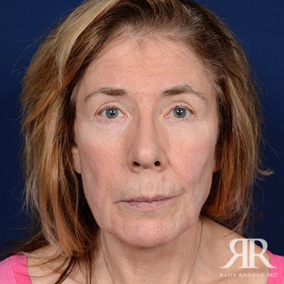 Facelift Before & After Gallery - Patient 831072 - Image 1