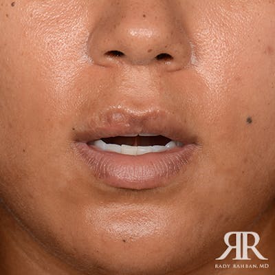 Lip Reduction / Lip Correction Before & After Gallery - Patient 103583 - Image 2