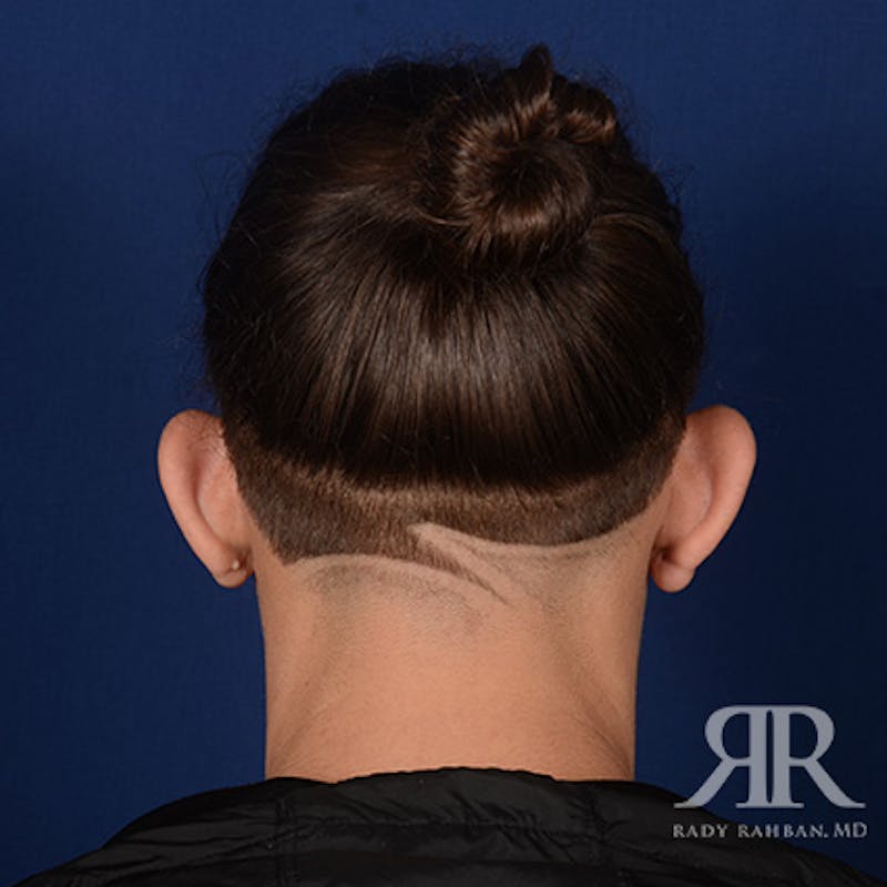 Ear Pinning Surgery Before & After Gallery - Patient 255708 - Image 5