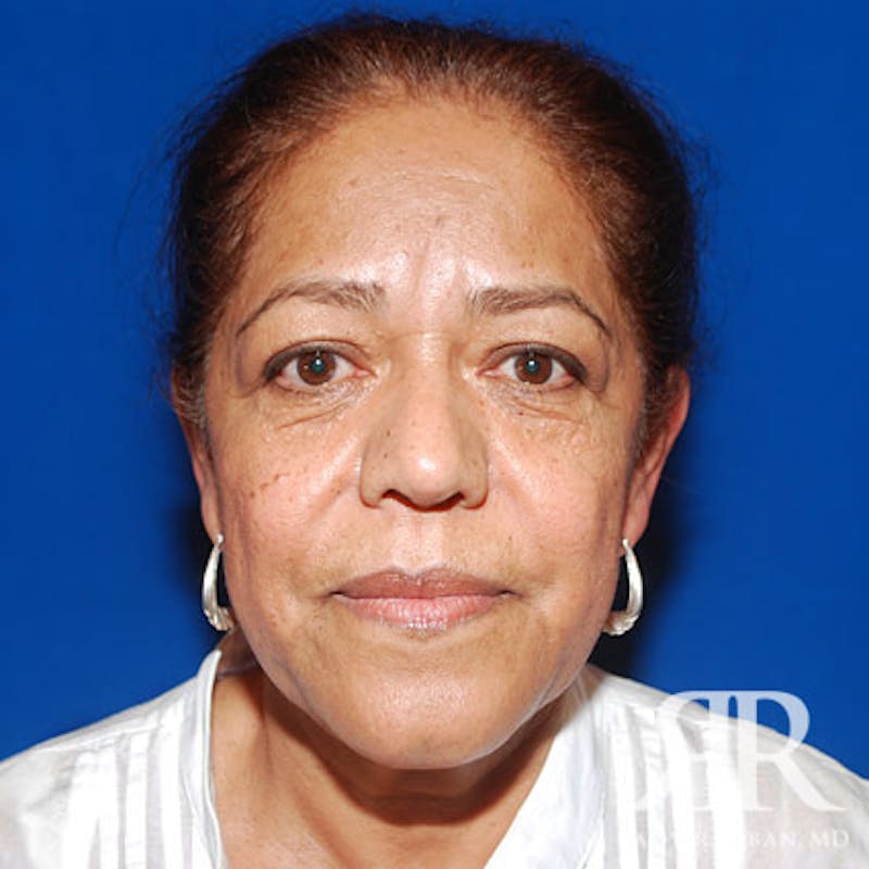 Browlift Before & After Gallery - Patient 402125 - Image 1