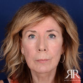 Facelift Before & After Gallery - Patient 831072 - Image 2