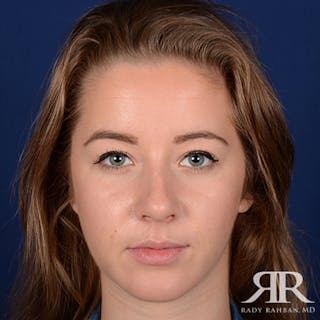 Chin Augmentation Before & After Gallery - Patient 374487 - Image 2