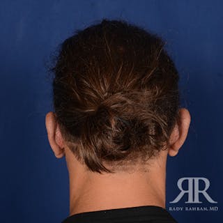 Ear Pinning Surgery Before & After Gallery - Patient 255708 - Image 6