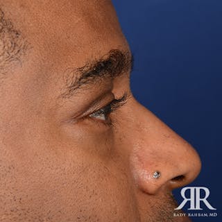 Eyelid Surgery Before & After Gallery - Patient 237243 - Image 6