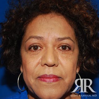 Browlift Before & After Gallery - Patient 402125 - Image 2