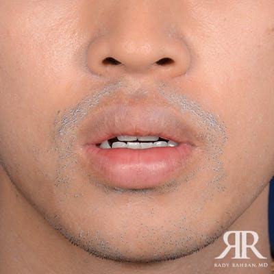 Lip Reduction / Lip Correction Before & After Gallery - Patient 324006 - Image 1