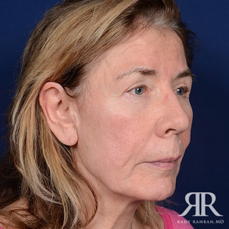 Facelift Before & After Gallery - Patient 831072 - Image 3