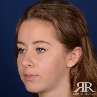 Chin Augmentation Before & After Gallery - Patient 374487 - Image 4
