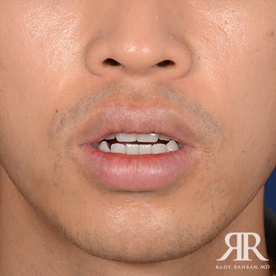 Lip Reduction / Lip Correction Before & After Gallery - Patient 324006 - Image 2
