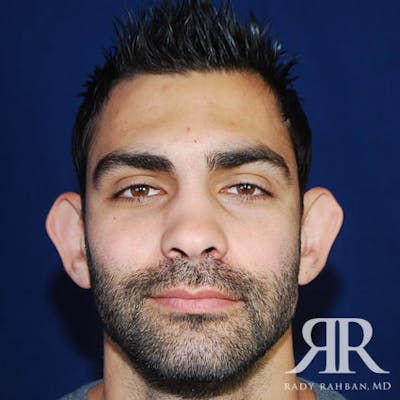 Ear Pinning Surgery Before & After Gallery - Patient 817713 - Image 1