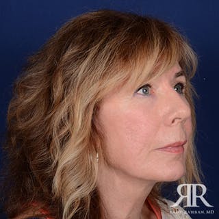 Facelift Before & After Gallery - Patient 831072 - Image 4