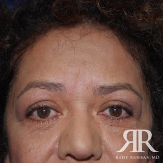 Browlift Before & After Gallery - Patient 402125 - Image 4