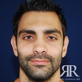 Ear Pinning Surgery Before & After Gallery - Patient 817713 - Image 2