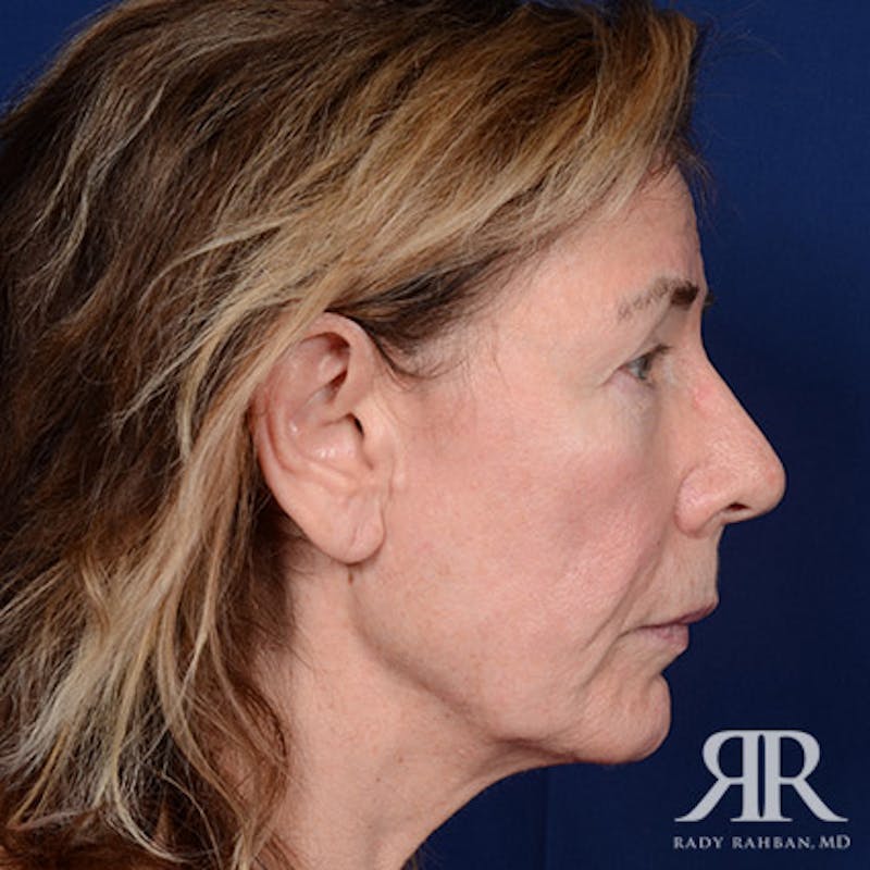 Facelift Before & After Gallery - Patient 831072 - Image 5