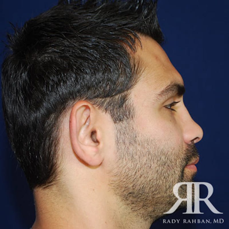 Ear Pinning Surgery Before & After Gallery - Patient 817713 - Image 3