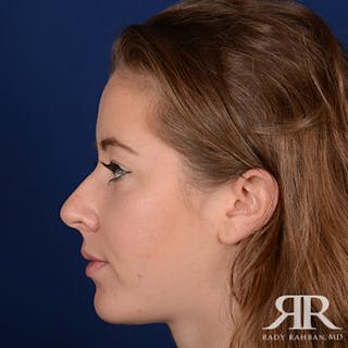 Chin Augmentation Before & After Gallery - Patient 374487 - Image 6