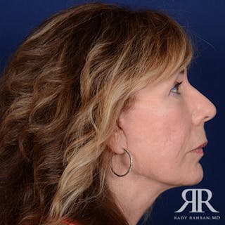 Facelift Before & After Gallery - Patient 831072 - Image 6