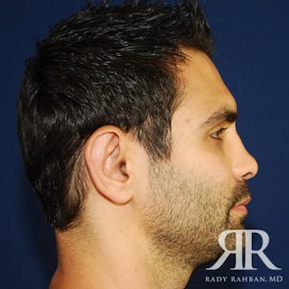 Ear Pinning Surgery Before & After Gallery - Patient 817713 - Image 4