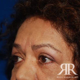 Browlift Before & After Gallery - Patient 402125 - Image 6