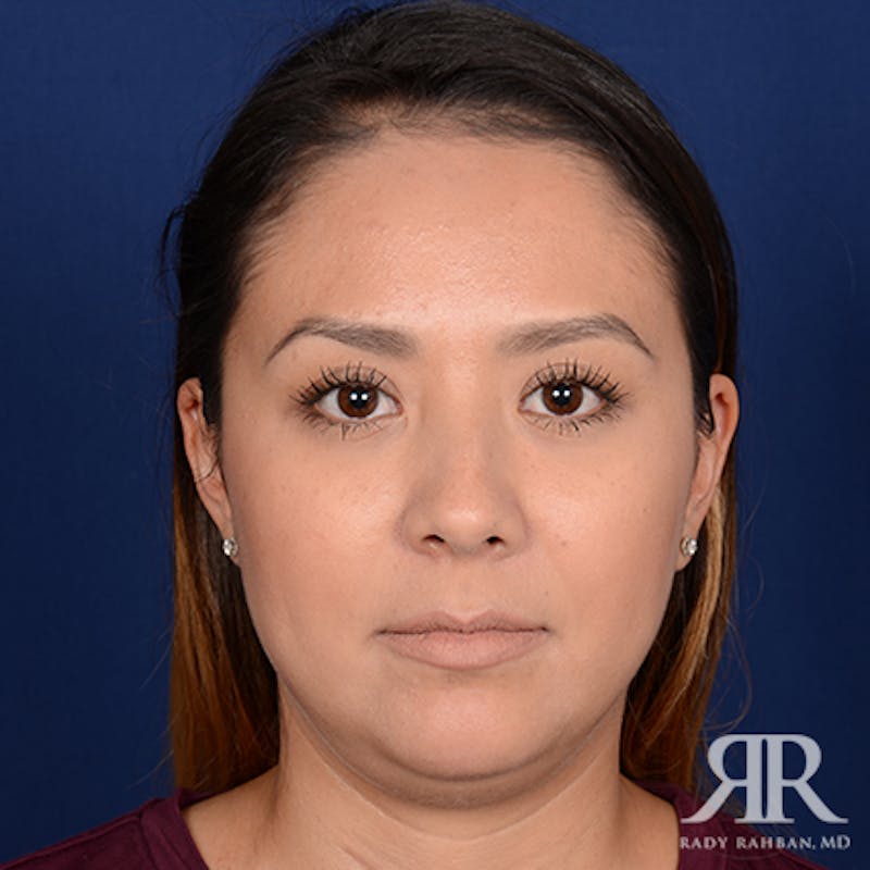 Chin Augmentation Before & After Gallery - Patient 173017 - Image 1