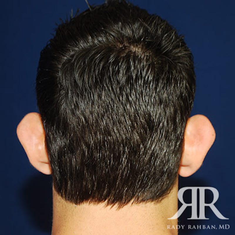 Ear Pinning Surgery Before & After Gallery - Patient 817713 - Image 5