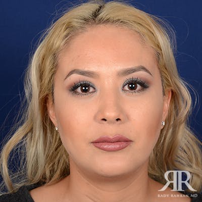 Chin Augmentation Before & After Gallery - Patient 173017 - Image 2
