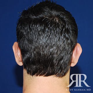 Ear Pinning Surgery Before & After Gallery - Patient 817713 - Image 6