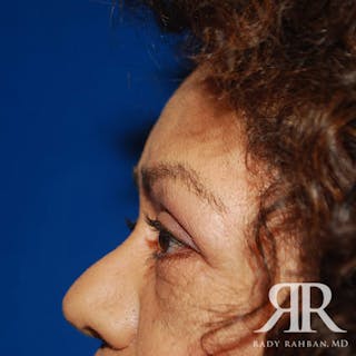 Browlift Before & After Gallery - Patient 402125 - Image 8