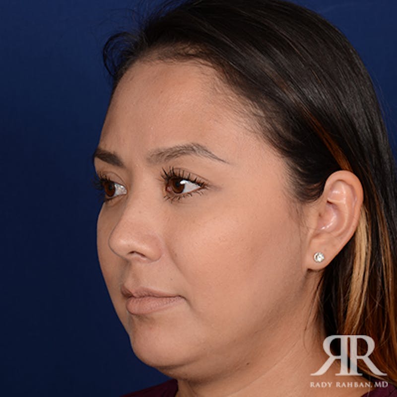 Chin Augmentation Before & After Gallery - Patient 173017 - Image 3