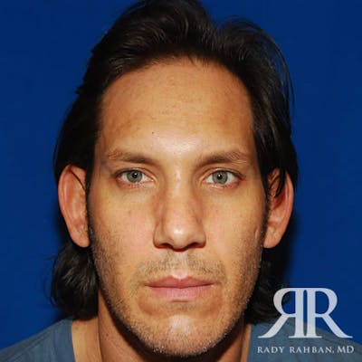 Ear Pinning Surgery Before & After Gallery - Patient 427324 - Image 1