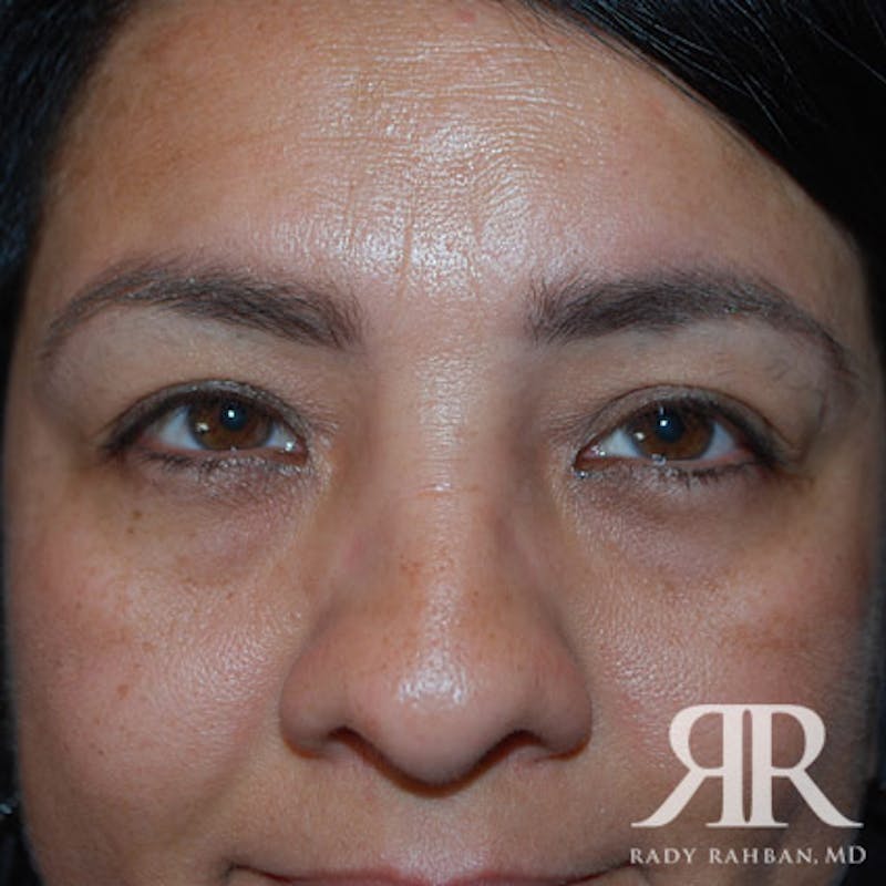 Browlift Before & After Gallery - Patient 265329 - Image 1