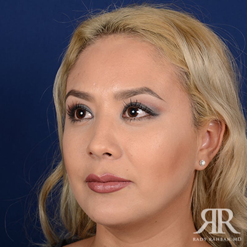 Chin Augmentation Before & After Gallery - Patient 173017 - Image 4