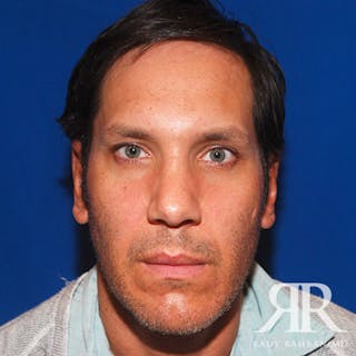 Ear Pinning Surgery Before & After Gallery - Patient 427324 - Image 2