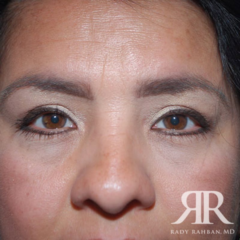 Browlift Before & After Gallery - Patient 265329 - Image 2