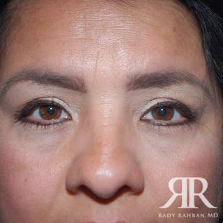 Browlift Before & After Gallery - Patient 265329 - Image 2