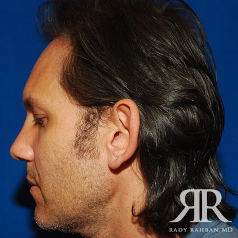 Ear Pinning Surgery Before & After Gallery - Patient 427324 - Image 3