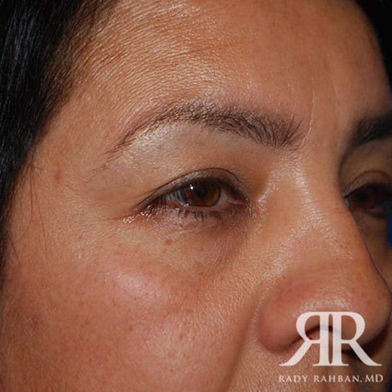 Browlift Before & After Gallery - Patient 265329 - Image 3