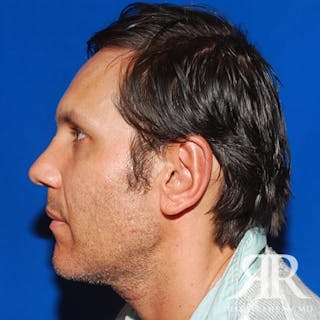 Ear Pinning Surgery Before & After Gallery - Patient 427324 - Image 4