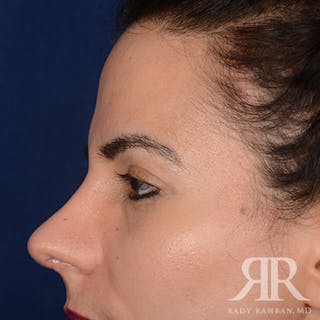 Eyelid Surgery Before & After Gallery - Patient 405424 - Image 6