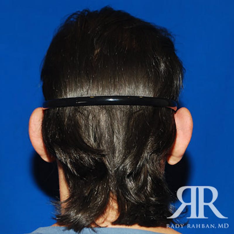 Ear Pinning Surgery Before & After Gallery - Patient 427324 - Image 5