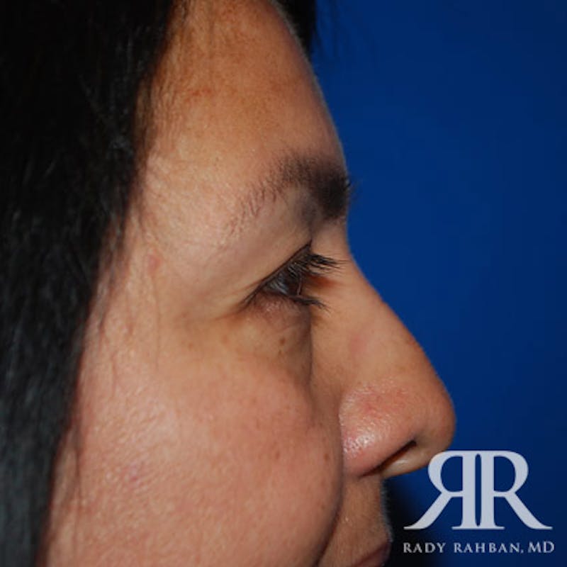 Browlift Before & After Gallery - Patient 265329 - Image 5