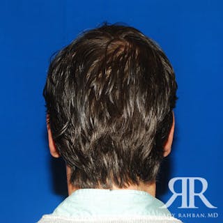 Ear Pinning Surgery Before & After Gallery - Patient 427324 - Image 6