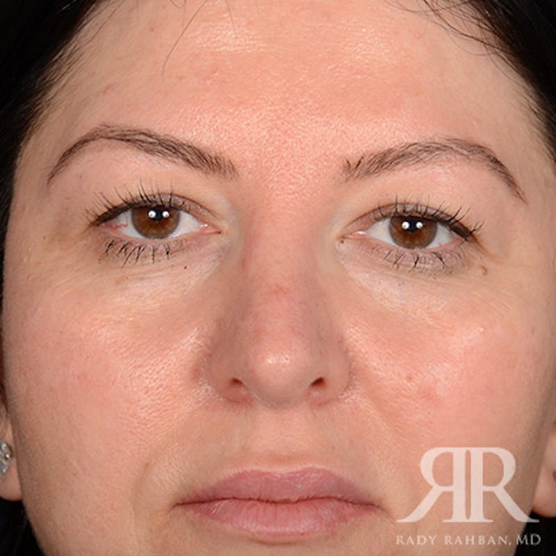 Eyelid Surgery Before & After Gallery - Patient 366009 - Image 1