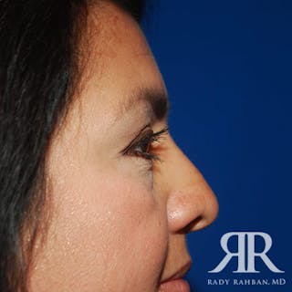 Browlift Before & After Gallery - Patient 265329 - Image 6