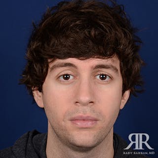 Chin Augmentation Before & After Gallery - Patient 354287 - Image 2