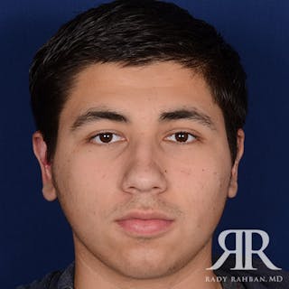 Ear Pinning Surgery Before & After Gallery - Patient 101619 - Image 2